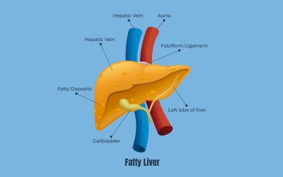 Does Diet Cause Fatty Liver?