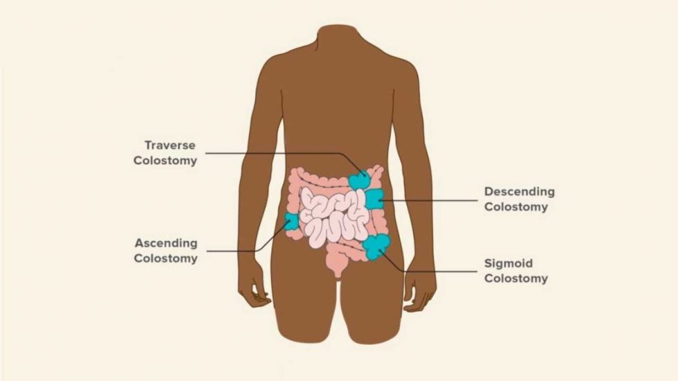 Colostomy: A Surgical Procedure That Diverts Stool - Dr Praveen Kammar