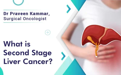 What is Second Stage Liver Cancer?