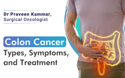 Understanding Colon Cancer : its Types, Symptoms, and Treatment