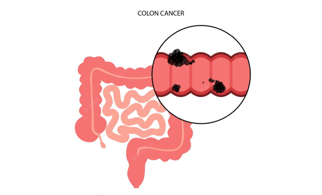 colon-cancer-stage 