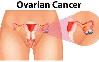 Stages of Ovarian Cancer : A Patient’s Journey to Understanding