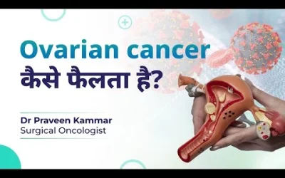 जानिए Ovarian cancer कैसे फैलता है?