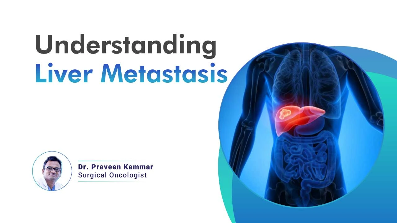 what is Liver Metastasis ? what is Liver Metastasis ?