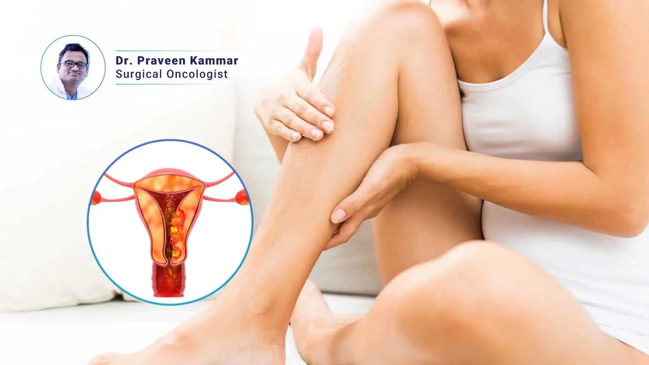 Uterine Cancer and Leg Pain